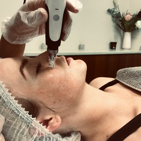 Cosmetic Skin Needling |  Collagen Induction Therapy